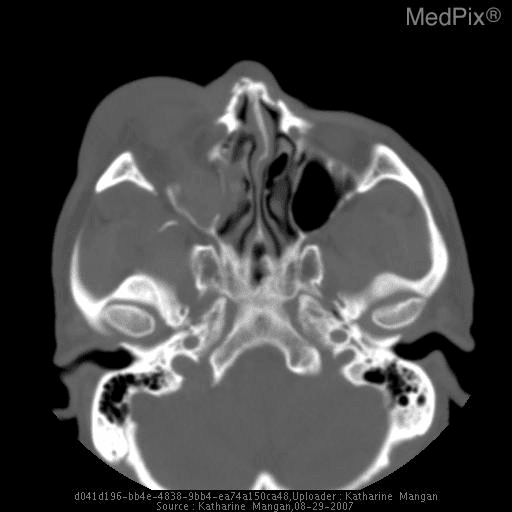 **Imaging Modality:** Non-contrast Computed Tomography (CT) of the head/maxillofacial region, axial view.