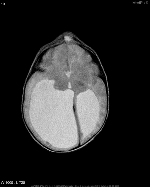 **Imaging Modality:** Non-contrast Computed Tomography (CT) scan of the head.