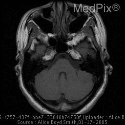 **Imaging Modality:** Magnetic Resonance Imaging (MRI), T1-weighted axial sequence.
**Anatomical Region:** Posterior cranial fossa at the level of the cerebellopontine angle (CPA) and petrous temporal bone.
**Observed Pathology:** There is a well-circumscribed, extra-axial soft tissue mass located in the right cerebellopontine angle cistern. The lesion appears mildly hypointense to isointense relative to the adjacent brain parenchyma on this T1-weighted image.
**Characteristic Visual Features:**
- **Location:** The mass is situated laterally to the pons and anterior to the cerebellum.
- **Morphology:** The lesion demonstrates a broad-based attachment along the posterior aspect of the petrous temporal bone, suggestive of a dural-based origin.
- **Mass Effect:** There is subtle compression and medial displacement of the adjacent brainstem (pons) and right cerebellar hemisphere.
- **Key Differentiating Feature:** Notably, the mass is extrinsic to the internal auditory canal (IAC), which appears relatively spared compared to the typical presentation of a vestibular schwannoma.
**Clinical Context/Differential:** The imaging features are highly suggestive of a CPA meningioma. Differential considerations for masses in this location include acoustic schwannoma, epidermoid cyst, and trigeminal neuroma.