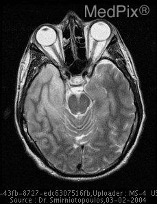 **Imaging Modality:** Magnetic Resonance Imaging (MRI), axial section.