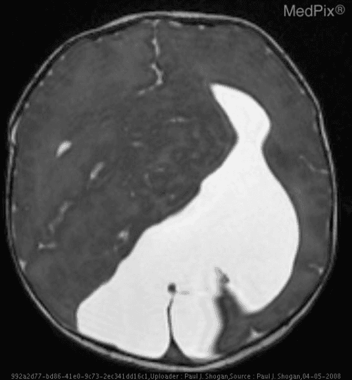 **Imaging Modality:** Axial T2-weighted Magnetic Resonance Imaging (MRI) of the brain.