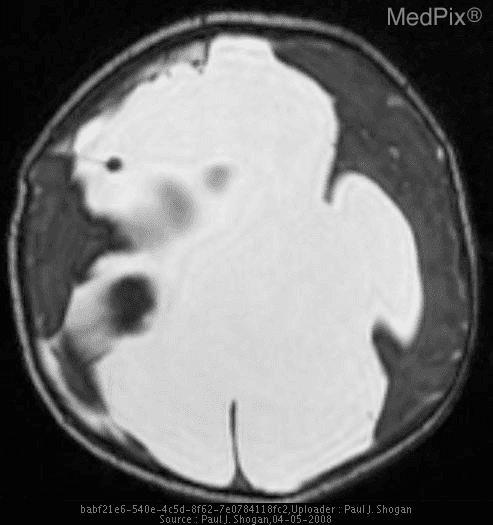 **Imaging Modality:** T2-weighted axial Magnetic Resonance Imaging (MRI) of the brain.