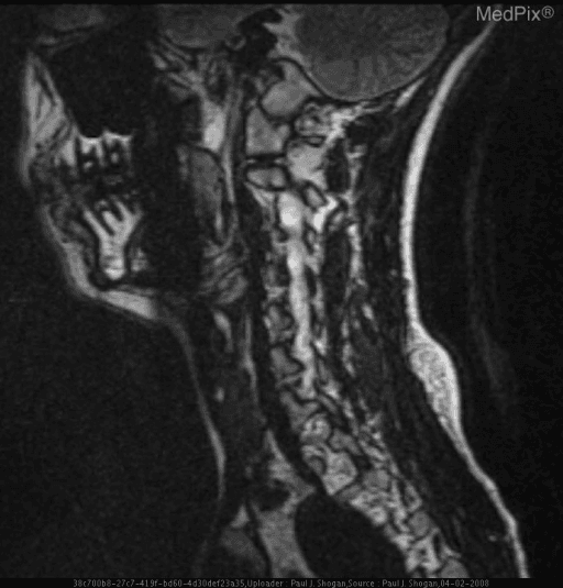 **Imaging Modality:** Sagittal Magnetic Resonance Imaging (MRI), T2-weighted sequence.
**Anatomical Region:** Cervical spine and posterior fossa, including the brainstem (medulla oblongata), cerebellum, and upper spinal cord.
**Observed Pathology:** The image demonstrates the neuroanatomical structures associated with Lateral Medullary Syndrome (Wallenberg Syndrome). While the acute infarct may be subtle on this specific sagittal view, the focus is on the regional anatomy of the medulla oblongata and its proximity to the cerebellum and vertebral-basilar arterial distribution.
**Characteristic Visual Features:**
- **Sagittal View:** Clear visualization of the craniovertebral junction and the brainstem.
- **Brainstem:** The medulla oblongata is visible anterior to the fourth ventricle and cerebellum.
- **Spinal Cord:** Intact signal intensity of the cervical spinal cord.
- **Soft Tissue:** Visual representation of the posterior neck musculature and cervical vertebrae.
**Relevant Clinical Context:** Lateral medullary infarction typically results from occlusion of the Posterior Inferior Cerebellar Artery (PICA) or the vertebral artery. Key diagnostic cues involve identifying ischemia within the retro-olivary (lateral) portion of the medulla, which houses the vestibular nuclei, spinothalamic tract, and descending sympathetic fibers.
