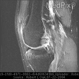 **Imaging Modality:** Sagittal T2-weighted fat-suppressed Magnetic Resonance Imaging (MRI).
**Anatomical Region:** Lateral-to-midline view of the human knee joint, including the distal femur, proximal tibia, patella, and posterior soft tissue structures.
**Observed Pathology:** The image demonstrates a posterior cruciate ligament (PCL) injury. The PCL appears thickened with heterogeneous, increased intrasubstance signal intensity, consistent with a partial-thickness tear or high-grade sprain. While the ligamentous fibers maintain some continuity, there is significant blurring of the normal low-signal (dark) morphology.
**Characteristic Visual Features:**
- **Signal Abnormality:** Elevated T2 signal within the PCL fibers indicating edema and hemorrhage.
- **Morphology:** Loss of the characteristic "hockey stick" or crisp curvilinear black appearance of a healthy PCL.
- **Associated Findings:** Mild joint effusion is visible in the suprapatellar bursa. The surrounding soft tissues and posterior capsule show reactive hyperintensity.
**Key Diagnostic Features:** Intrasubstance signal changes in the PCL on fluid-sensitive sequences are the primary diagnostic indicators for distinguishing ligamentous strain or partial rupture from a complete discontinuity (full-thickness tear).