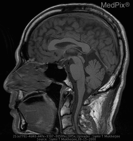 **Imaging Modality:** Magnetic Resonance Imaging (MRI), T1-weighted sequence.