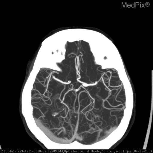 **Imaging Modality:** Computed Tomography Angiography (CTA), axial maximum intensity projection (MIP) reconstruction.