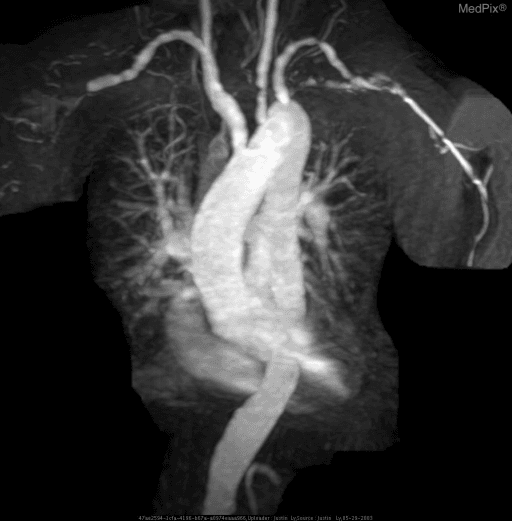 **Imaging Modality:** Contrast-enhanced Magnetic Resonance Angiography (MRA), Maximum Intensity Projection (MIP) reconstruction.