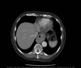 **Imaging Modality:** Axial computed tomography (CT) of the chest/upper abdomen with intravenous contrast.
**Anatomical Region:** Lower mediastinum and diaphragmatic hiatus.
**Observed Pathology:** Sliding hiatal hernia. The image demonstrates the superior migration of the gastroesophageal junction and a portion of the proximal stomach into the posterior mediastinum, located posterior to the heart and anterior to the descending aorta.
**Characteristic Visual Features:**
- A soft tissue mass containing an internal air-fluid level and heterogeneous contents (oral contrast and gas) is visible within the retrocardiac space.
- The gastric herniation causes a focal widening of the diaphragmatic hiatus.
- The descending thoracic aorta shows mild atherosclerotic calcification.
- The liver, spleen, and visible portions of the lung parenchyma appear unremarkable at this level.
**Differentiating Features:** The central location of the stomach within the hiatus, rather than adjacent to a normally positioned gastroesophageal junction, is characteristic of a sliding hiatal hernia (Type I) rather than a paraesophageal hernia.
**Clinical Significance:** This finding is a common cause of retrocardiac masses on chest radiography and can correlate with symptoms of gastroesophageal reflux or mechanical compression.