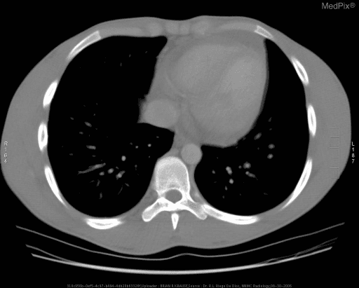 **Imaging Modality:** Computed Tomography (CT), axial section.
**Anatomical Region:** Thorax at the level of the heart and lower mediastinum.
**Observed Pathology:** The image demonstrates a significant soft-tissue attenuation mass located in the anterior mediastinum. The lesion is characterized by a homogeneous appearance and demonstrates a mass effect, subtly displacing adjacent cardiovascular structures.
**Characteristic Visual Features:**
* **Mediastinal Widening:** There is an expansive, well-circumscribed soft-tissue density occupying the anterior mediastinal space, consistent with lymphadenopathy or a primary mediastinal tumor.
* **Cardiovascular Landmarks:** The mass is situated anterior to the heart and great vessels. The descending aorta and vertebral body appear unremarkable.
* **Pulmonary Parenchyma:** The lung fields are largely clear without overt evidence of large pulmonary nodules or consolidations at this level.
* **Pleural Space:** No significant pleural effusions are visualized in this section.
**Clinical Context/Differentiating Features:** The location and homogeneous morphology in the anterior mediastinum are highly suggestive of lymphoma (e.g., Hodgkin’s or Diffuse Large B-cell Lymphoma), though the differential diagnosis for an anterior mediastinal mass includes thymoma, teratoma, and thyroid lesions.