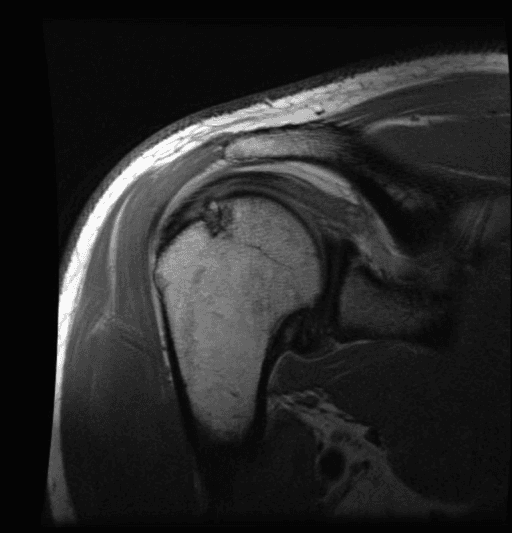 **Imaging Modality:** Magnetic Resonance Imaging (MRI)
**Anatomical Region:** Right shoulder (glenohumeral joint)
**View:** Coronal oblique T1-weighted sequence
**Observed Pathology:**
The image demonstrates a classic **Hill-Sachs lesion**, characterized by a cortical depression and marrow signal abnormality on the posterolateral aspect of the superior humeral head. This impaction fracture is a hallmark sign of prior anterior glenohumeral dislocation.
**Characteristic Visual Features:**
* **Humeral Head:** Focal wedge-shaped defect in the subchondral bone of the superolateral humeral head.
* **Glenohumeral Alignment:** The humeral head is currently reduced within the glenoid fossa.
* **Surrounding Structures:** Visualization of the acromion, clavicle, and deltoid musculature. There is a suggestion of labral pathology (likely a Bankart lesion) at the inferior glenoid rim, typically associated with this injury pattern.
**Clinical Context & Significance:**
The presence of a Hill-Sachs lesion is a critical radiologic marker for shoulder instability. It represents the "engagement" of the humeral head against the anterior glenoid rim during a dislocation event. This finding is essential for preoperative planning to assess the risk of recurrent instability and to determine the need for specialized procedures like a Remplissage or bone grafting.