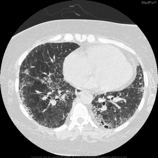 **Imaging Modality:** High-resolution computed tomography (HRCT) of the chest, axial section.