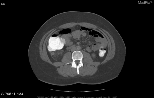 **Imaging Modality:** Axial Computed Tomography (CT) of the abdomen and pelvis with oral contrast.
**Anatomical Region:** Lower abdomen and right iliac fossa at the level of the lumbar vertebrae.
**Observed Pathology:** The image demonstrates findings highly suggestive of acute appendicitis. There is a blind-ending, tubular structure in the right lower quadrant exhibiting wall thickening and significant periappendiceal fat stranding (increased attenuation of the surrounding mesenteric fat).
**Characteristic Visual Features:**
- **Fat Stranding:** Obvious hazy, linear opacities in the fat adjacent to the cecum and appendix, indicating localized inflammation.
- **Contrast Opacification:** Oral contrast is visible within the cecum and descending colon, but fails to fill the lumen of the inflamed appendix.
- **Anatomy:** The cecum is displaced slightly medially. No evidence of free intraperitoneal air or large abscess formation is visualized in this single slice.
**Clinical Context:** These radiologic features, in the context of migratory periumbilical pain to the right lower quadrant in a pediatric/young adult patient, are diagnostic of acute inflammatory appendicitis.