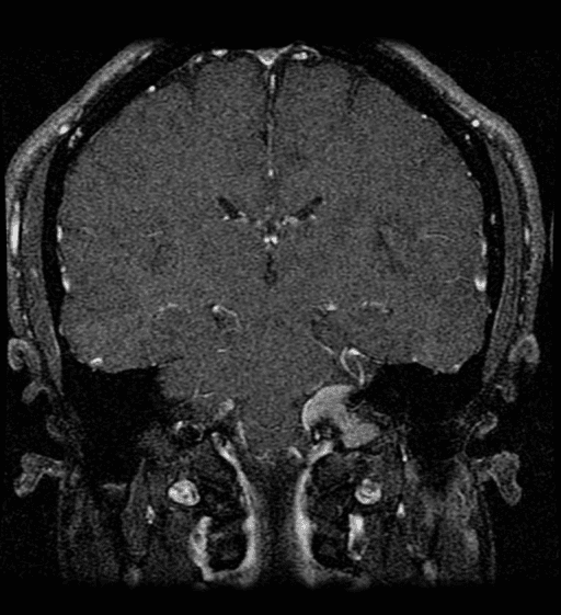**Imaging Modality:** Contrast-enhanced Magnetic Resonance Imaging (MRI), coronal section.
**Anatomical Region:** Skull base at the level of the left jugular foramen and cerebellopontine angle (CPA).
**Observed Pathology:** A well-circumscribed, intensely and homogeneously enhancing extra-axial mass is located at the left jugular foramen. The lesion extends superiorly toward the CPA and demonstrates a broad-based attachment along the petrous temporal bone.
**Characteristic Visual Features:**
* **Enhancement Pattern:** The mass shows uniform contrast uptake, characteristic of a highly vascular or cellular meningioma or schwannoma.
* **Morphology:** The lesion appears solid with smooth margins, exerting mild mass effect on the adjacent brainstem and cerebellum.
* **Dural Tail Sign:** There is a linear thickening of the adjacent dura mater (dural tail), which is highly suggestive of a meningioma.
* **Absence of Flow Voids:** The internal signal is relatively homogeneous without the prominent "salt and pepper" flow voids typically seen in paragangliomas (glomus jugulare).
**Key Diagnostic Features:** The location within the jugular foramen and the presence of a dural tail are primary cues for differentiating between a jugular foramen meningioma and a schwannoma or paraganglioma.