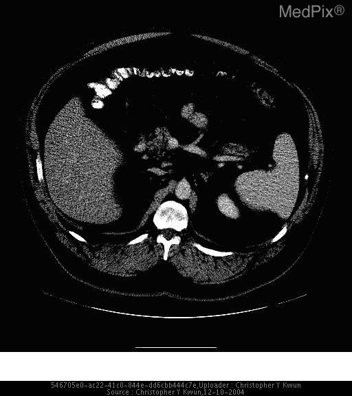 **Imaging Modality:** Contrast-enhanced axial Computed Tomography (CT) scan.