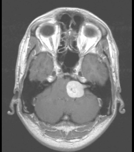 **Modality:** Magnetic Resonance Imaging (MRI), Axial T1-weighted post-contrast sequence.
**Anatomic Region:** Posterior cranial fossa at the level of the cerebellopontine angle (CPA) and internal auditory canal (IAC).
**Observation:** There is a well-circumscribed, intensely enhancing extra-axial mass located in the left cerebellopontine angle. The lesion exhibits the classic "ice-cream cone" configuration, characterized by a bulbous component within the CPA cistern and a narrow extension (the "cone") into the widened left internal auditory canal.
**Characteristic Features:** The mass shows heterogeneous enhancement with internal areas of lower signal intensity, suggestive of cystic degeneration. It exerts significant mass effect on the adjacent brainstem (pons) and the left cerebellar hemisphere, with mild compression of the fourth ventricle.
**Diagnostic Entity:** The findings are highly characteristic of a Vestibular Schwannoma (Acoustic Neuroma).
**Key Differentiating Features:** The presence of the intracanalicular component and the widening of the IAC help distinguish this from other CPA masses, such as meningiomas (which typically lack IAC extension and may demonstrate a "dural tail") or epidermoid cysts (which generally do not enhance with gadolinium).