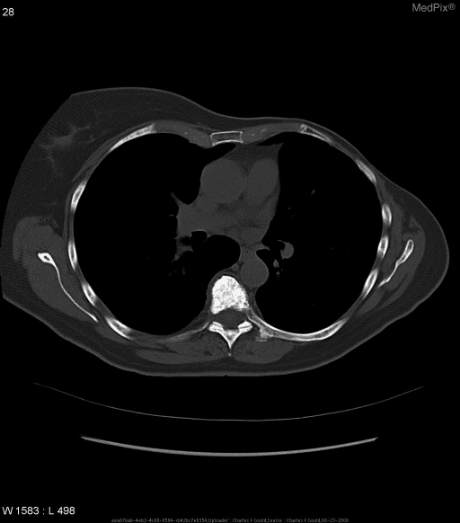 **Imaging Modality:** Axial computed tomography (CT) scan.
**Anatomical Region:** Mid-thoracic spine at the level of the mediastinum and pulmonary hilum.
**Observed Pathology:** The image demonstrates a classic "ivory vertebra" sign. A single thoracic vertebral body exhibits diffuse, homogeneous, and intense sclerosis (increased bone density) throughout the entire marrow space.
**Characteristic Visual Features:**
* **Hyperdensity:** Markedly increased radiopacity of the vertebral body compared to adjacent skeletal structures and posterior elements.
* **Morphology:** The vertebral body maintains its normal height, shape, and cortical margins without evidence of expansion, fragmentation, or cortical destruction.
* **Distribution:** Isolated involvement of the vertebral body, with the posterior elements (laminae and spinous process) appearing relatively spared or less densely sclerotic.
* **Surrounding Structures:** Visible ribs, sternum, and soft tissues appear within normal limits for this window setting.
**Clinical Significance:** This radiologic finding is a key diagnostic cue for osteoblastic metastases (e.g., prostate or breast cancer), Paget’s disease (though usually associated with osseous expansion), or lymphoma (specifically Hodgkin lymphoma). It is differentiated from other sclerotic vertebral patterns by its uniform, high-density "ivory" appearance.