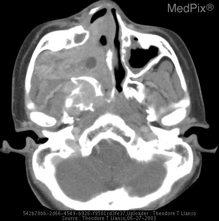 **Imaging Modality:** Axial Computed Tomography (CT) scan with soft tissue window settings.
**Anatomical Region:** Skull base and paranasal sinuses, specifically focusing on the nasopharynx and the pterygopalatine fossa.
**Observed Pathology:** Large, heterogeneous soft tissue mass consistent with Juvenile Nasopharyngeal Angiofibroma (JNA). The lesion is centered in the right nasopharyngeal region with significant aggressive extension.
**Characteristic Visual Features:**
* **Expansion and Destruction:** The mass demonstrates aggressive local behavior, characterized by the destruction of the posterior wall of the right maxillary sinus and the pterygoid plates.
* **Infiltration:** The tumor fills the right nasal cavity and extends laterally into the right infratemporal fossa and pterygopalatine fossa.
* **Displacement:** There is marked opacification of the right maxillary sinus and deviation of the nasal septum to the left.
* **Bony Hallmarks:** The image displays a widening of the sphenopalatine foramen, a classic radiologic indicator for JNA.
**Key Diagnostic Features:** The combination of a highly vascular-appearing soft tissue mass in the nasopharynx of a young patient, widening of the sphenopalatine foramen, and anterior bowing or destruction of the posterior maxillary sinus wall (Holman-Miller sign) are definitive features for this entity.