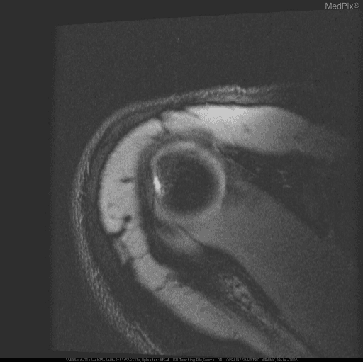 **Imaging Modality:** Magnetic Resonance Imaging (MRI)
**Anatomical Region:** Right shoulder girdle, specifically the glenohumeral joint.
**Observed Pathology and Visual Features:**
This axial T2-weighted or proton density (PD) MRI sequence demonstrates characteristic findings of post-traumatic glenohumeral instability:
* **Hill-Sachs Deformity:** A distinct cortical depression and bone marrow signal abnormality are visible on the posterolateral aspect of the humeral head, representing a compression fracture.
* **Bankart Lesion:** There is evidence of disruption or tearing of the anteroinferior glenoid labrum, accompanied by irregularity of the adjacent glenoid rim.
* **Joint Space:** Mild joint effusion or intra-articular fluid is present, outlining the glenohumeral structures.
* **Soft Tissues:** The surrounding deltoid musculature and subcutaneous tissues appear intact, though minor perivascular or interstitial edema may be present.
**Clinical Context:**
The combination of a Hill-Sachs lesion and a Bankart lesion is highly indicative of prior anterior glenohumeral dislocation.
**Diagnostic Significance:**
These findings are critical for indexing cases of recurrent shoulder instability and preoperative planning for capsulolabral repair (e.g., Bankart repair) and assessing the risk of future subluxation events.