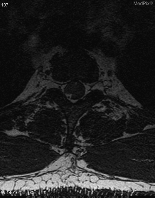 **Imaging Modality:** Magnetic Resonance Imaging (MRI), axial T1-weighted sequence.
**Anatomical Region:** Thoracic spine at the level of the vertebral body and neural canal.
**Observed Pathology:** There is a well-circumscribed, lobulated mass located within the spinal canal. The lesion is situated in the intradural extramedullary space. It demonstrates heterogeneous signal intensity, primarily isointense to the spinal cord, with focal areas of hyperintensity.
**Characteristic Visual Features:** The mass occupies a significant portion of the spinal canal, causing secondary compression and displacement of the spinal cord (the "cord flattening" sign). The lesion appears to be closely associated with the nerve roots or the meningeal lining. There is no evidence of gross vertebral body destruction or paravertebral extension in this specific slice.
**Key Diagnostic Features:** The location within the thecal sac but external to the cord parenchyma is characteristic of intradural extramedullary neoplasms such as schwannoma, meningioma, or neurofibroma. The preservation of the epidural fat plane and the displacement of the subarachnoid CSF space are key indicators of the intradural compartment origin.