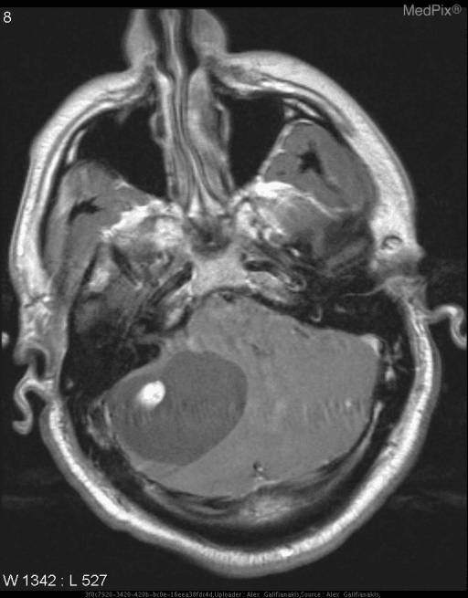 **Imaging Modality:** Magnetic Resonance Imaging (MRI), T1-weighted axial sequence with gadolinium contrast enhancement.