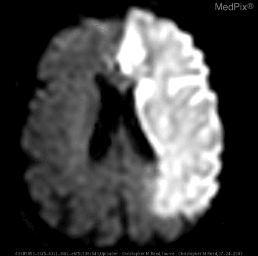 **Imaging Modality:** Magnetic Resonance Imaging (MRI), Diffusion-Weighted Imaging (DWI).
**Anatomical Region:** Axial section of the brain at the level of the lateral ventricles and basal ganglia.
**Observed Pathology:** Large-scale acute ischemic infarction involving the left cerebral hemisphere.
**Characteristic Visual Features:**
* **Signal Intensity:** Prominent, confluent area of hyperintensity (diffusion restriction) indicative of cytotoxic edema.
* **Distribution:** The pathology follows a specific vascular territorial pattern, involving the entire left Anterior Cerebral Artery (ACA) and Middle Cerebral Artery (MCA) territories.
* **Sparing:** There is distinct sparing of the Posterior Cerebral Artery (PCA) territory and the entire right cerebral hemisphere.
* **Mass Effect:** Subtle effacement of the left lateral ventricle and adjacent cortical sulci is visible, suggesting early focal edema.
**Clinical Context:** Findings are diagnostic of a large-vessel occlusion (LVO), specifically involving the left internal carotid artery (ICA) terminus or the proximal segments of the ACA and MCA simultaneously. This represents a major acute ischemic stroke.
**Key Diagnostic Features:** The sharp demarcation at the midline and the territorial confinement assist in differentiating vascular infarction from neoplastic or inflammatory processes.
