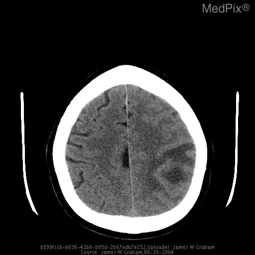 **Imaging Modality:** Non-contrast axial CT scan of the head.