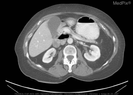 **Imaging Modality:** Contrast-enhanced Computed Tomography (CT) of the abdomen.
**Anatomical Region:** Axial section at the level of the upper abdomen, displaying the liver, gallbladder, pancreas, kidneys, and mesenteric vasculature.
**Observed Pathology:** The image demonstrates findings consistent with intestinal malrotation. A primary diagnostic cue is the inversion of the normal anatomical relationship between the superior mesenteric artery (SMA) and the superior mesenteric vein (SMV).
**Characteristic Visual Features:**
* **Vascular Inversion:** The SMV is positioned to the left of the SMA, rather than its normal position to the right.
* **SMV Sign:** The mesenteric vessels show an altered orientation, which is a classic radiologic indicator of malrotation.
* **Organ Positioning:** While the liver and kidneys appear gross-anatomically normal in this slice, the midgut structures demonstrate abnormal mesenteric anchoring.
* **Absence of Volvulus:** No "whirlpool sign" is immediately visible in this specific axial plane, though the vascular transposition highly suggests underlying malrotation.
**Clinical Significance:** This congenital anomaly results from the failure of the midgut to undergo the normal 270-degree counterclockwise rotation during embryogenesis, predisposing the patient to midgut volvulus and internal herniation.