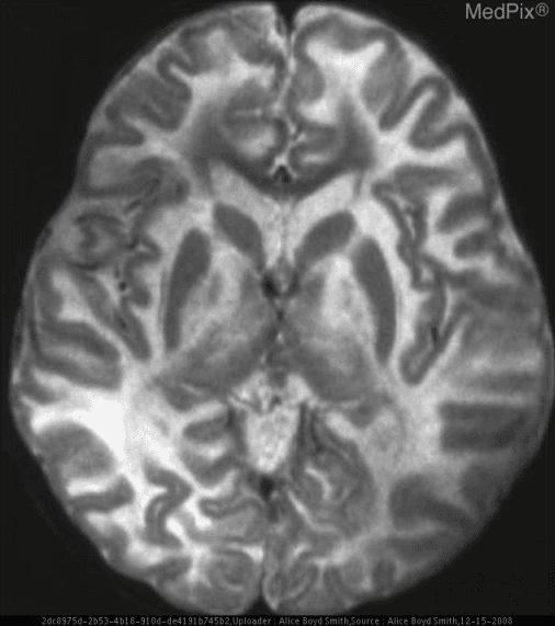 **Imaging Modality:** Magnetic Resonance Imaging (MRI), T2-weighted axial section.