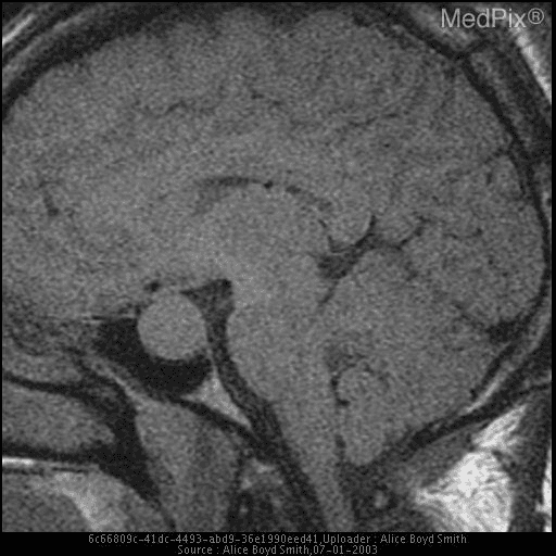 **Imaging Modality:** Sagittal Magnetic Resonance Imaging (MRI), likely T1-weighted sequence.