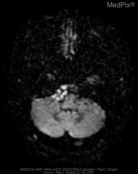 **Imaging Modality:** Magnetic Resonance Imaging (MRI), Axial Diffusion-Weighted Imaging (DWI).
**Anatomical Region:** Posterior fossa, specifically the prepontine and cerebellopontine angle (CPA) cisterns.
**Observed Pathology:** There is a lobulated, extra-axial mass located within the prepontine cistern, extending into the right CPA. The lesion demonstrates marked hyperintensity on DWI, indicating restricted diffusion.
**Characteristic Visual Features:** The mass is characterized by high signal intensity on this DWI sequence, which is a hallmark of intracranial epidermoid cysts. It exhibits a "creeping" or "cauliflower-like" morphology, filling the basal cisterns and exerting mild mass effect on the adjacent brainstem (pons and medulla). Foci of lower signal within the hyperintense mass likely represent trapped cerebrospinal fluid (CSF) channels.
**Key Diagnostic Features:** The combination of an extra-axial location in the CPA/prepontine cistern and restricted diffusion (high DWI signal) is highly specific for an intracranial epidermoid cyst, differentiating it from an arachnoid cyst, which would follow CSF signal and suppress on DWI.