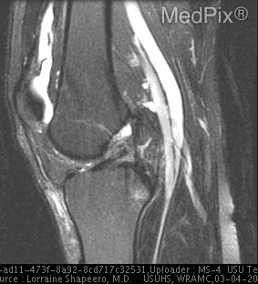 **Imaging Modality:** Sagittal T2-weighted fat-saturated Magnetic Resonance Imaging (MRI) of the knee.
