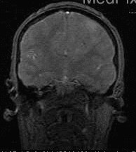 **Imaging Modality:** Coronal magnetic resonance imaging (MRI).