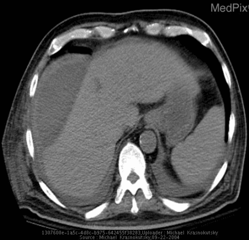 **Imaging Modality:** Computed Tomography (CT) scan of the upper abdomen, axial section.