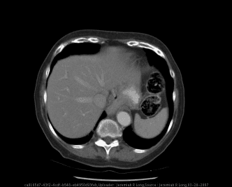 **Imaging Modality:** Contrast-enhanced Computed Tomography (CT), axial section.
**Anatomical Region:** Lower thorax/upper abdomen at the level of the diaphragmatic hiatus.
**Observed Pathology:** Sliding hiatal hernia.
**Characteristic Visual Features:** The image demonstrates a portion of the stomach herniating superiorly through the esophageal hiatus into the posterior mediastinum. Key landmarks include the liver (right), spleen (left), and the descending aorta. Centrally, a retrocardiac soft tissue mass representing the displaced gastric cardia is visible adjacent to the esophagus.
**Key Diagnostic Features:**
- Widening of the diaphragmatic hiatus.
- Intrathoracic displacement of the gastroesophageal junction.
- Presence of a gas-filled or contrast-containing gastric pouch above the level of the diaphragm, posterior to the heart.
- Absence of a distinct paraesophageal component, consistent with a Type I (sliding) hiatal hernia.
**Clinical Context:** This finding is typically associated with gastroesophageal reflux disease (GERD) and is a common incidental finding on cross-sectional imaging of the chest and abdomen.