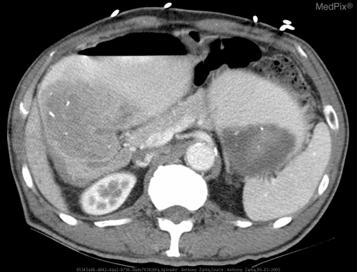 **Imaging Modality:** Contrast-enhanced axial Computed Tomography (CT) of the upper abdomen.
**Anatomical Region:** Upper abdomen, specifically visualizing the stomach, liver, spleen, pancreas, and left kidney.
**Observed Pathology:** Significant Gastric Outlet Obstruction (GOO). The image reveals marked distention of the stomach, which is filled with heterogeneous material (likely a combination of ingested food, secretions, and air), characteristic of a "succussion splash" appearance on imaging.
**Characteristic Visual Features:**
- **Gastric Dilation:** Severe gastric expansion occupying a large portion of the upper abdominal cavity.
- **Transition Zone:** The obstruction appears localized to the distal antrum or pyloric region, consistent with cicatricial narrowing from chronic peptic ulcer disease.
- **Associated Findings:** Presence of an air-fluid level within the stomach and compression of adjacent viscera. Small metallic surgical clips are visible on the anterior abdominal wall.
**Clinical Context & Diagnosis:** Findings are highly suggestive of Gastric Outlet Obstruction secondary to peptic ulcer disease (PUD), leading to chronic pyloric or duodenal stenosis.
**Differentiating Features:** The degree of gastric distention without an obvious intraluminal mass suggests a benign, chronic inflammatory or fibrotic etiology rather than acute malignancy.