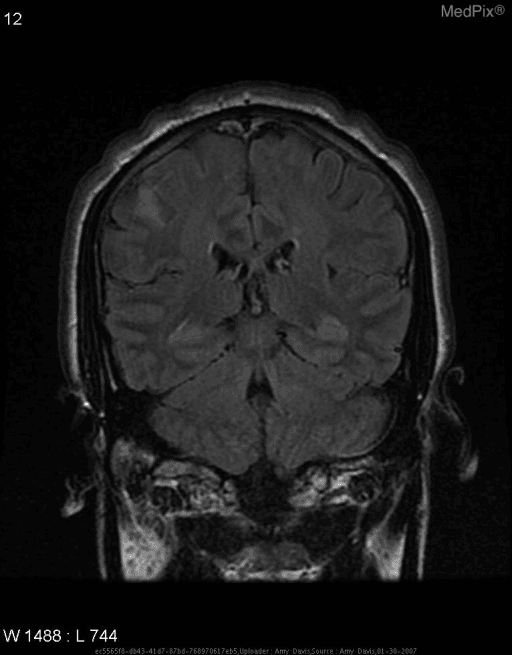 **Imaging Modality:** Magnetic Resonance Imaging (MRI), Coronal plane.