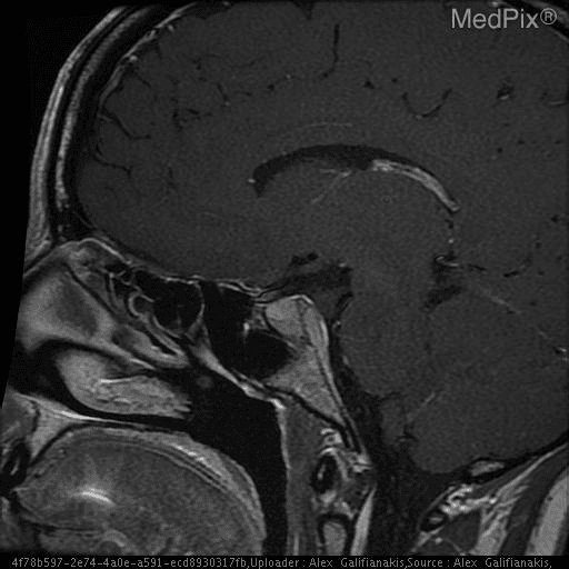 **Imaging Modality:** Magnetic Resonance Imaging (MRI), T1-weighted sagittal view with contrast enhancement.