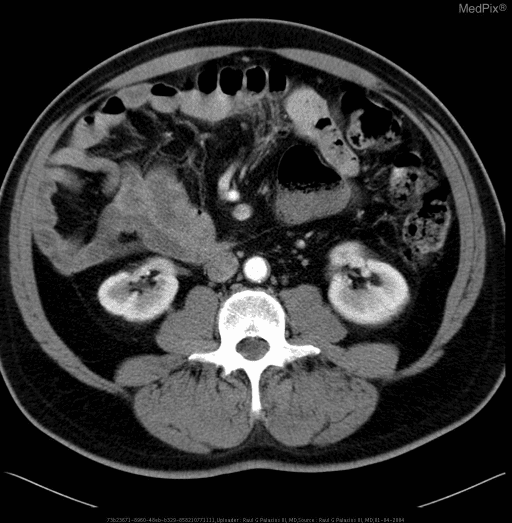 **Imaging Modality:** Axial Computed Tomography (CT) of the abdomen and pelvis with intravenous contrast.
**Anatomical Region:** Lower abdomen and right iliac fossa.
**Observed Pathology:** Findings are consistent with acute appendicitis. The image demonstrates a significantly distended, thick-walled appendix located in the right lower quadrant.
**Characteristic Visual Features:**
- **Appendiceal Distension:** The appendix appears dilated, exceeding the normal caliber threshold.
- **Wall Enhancement:** Prominent peripheral enhancement of the appendiceal wall indicates hyperemic inflammation.
- **Periappendiceal Fat Stranding:** Increased attenuation and haziness of the surrounding mesenteric fat suggest an acute inflammatory process and localized peritonitis.
- **Secondary Findings:** Mild reactive thickening of the adjacent cecal pole may be present. No definitive evidence of a calcified appendicolith or localized abscess formation is visible in this specific axial slice.
**Key Diagnostic Features:** The combination of a dilated appendix (>6 mm), mural thickening, and secondary periappendiceal fat stranding are the hallmark CT signs for diagnosing acute appendicitis.
**Clinical Context:** These radiologic findings correlate with clinical presentations of acute lower abdominal pain and signs of systemic inflammation.