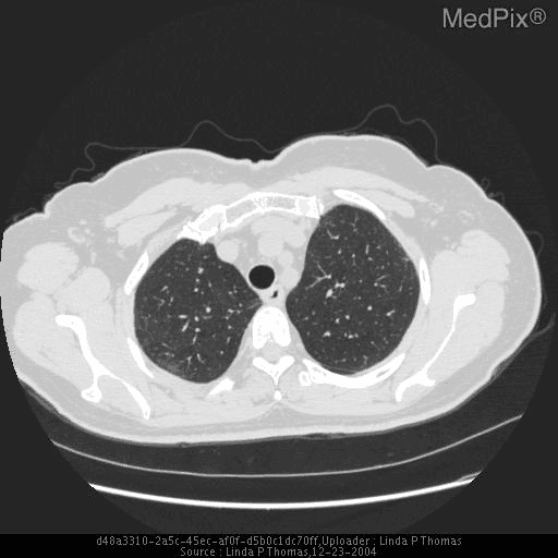 **Imaging Modality:** High-resolution computed tomography (HRCT) of the chest, axial plane.