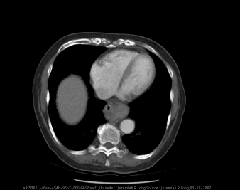 **Imaging Modality:** Axial computed tomography (CT) of the chest with intravenous and oral contrast.
**Anatomical Region:** Lower thorax at the level of the retrocardiac space and esophageal hiatus.
**Observed Pathology:** Sliding hiatal hernia (Type I).
**Characteristic Visual Features:**
The image demonstrates a soft tissue mass containing an internal air-fluid level located in the posterior mediastinum, situated directly behind the heart and anterior to the descending thoracic aorta. This represents the cranial displacement of the gastroesophageal junction and a portion of the proximal stomach through the esophageal hiatus into the thoracic cavity. The azygoesophageal recess is distorted by the herniated gastric contents.
**Relevant Landmarks:**
Key structures visualized include the cardiac silhouette (ventricles), the descending aorta, the vertebral body, and the liver dome (right). The oral contrast facilitates identification of the gastric lumen within the mediastinal herniation.
**Differentiating Features:**
The superior migration of the gastroesophageal junction above the diaphragmatic crus distinguishes this sliding hiatal hernia from a paraesophageal hernia, where the gastroesophageal junction typically remains in its normal anatomical position. No acute cardiopulmonary complications are visualized in this section.