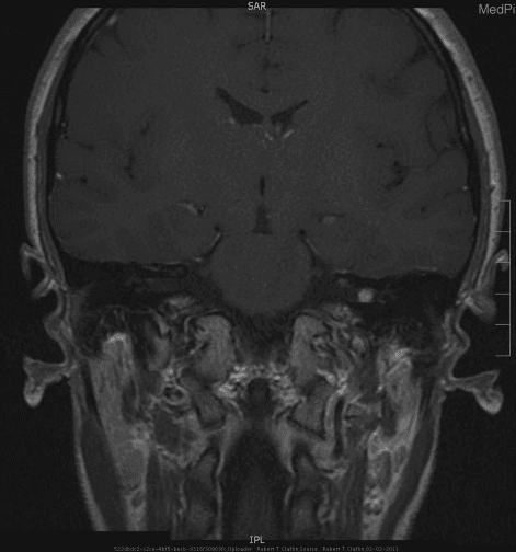 **Imaging Modality:** Gadolinium-enhanced Magnetic Resonance Imaging (MRI), coronal view.
**Anatomical Region:** Posterior cranial fossa, specifically the cerebellopontine angle (CPA).
**Observed Pathology:** A small, well-circumscribed, intensely enhancing focal mass is located in the left cerebellopontine angle. Based on clinical context, this lesion is a vestibular schwannoma. Notably, the mass appears primarily localized to the CPA without the classic "ice cream cone" appearance involving significant widening or extension into the internal auditory canal (IAC).
**Characteristic Visual Features:**
* **Signal Intensity:** High signal intensity (bright enhancement) following intravenous gadolinium administration on T1-weighted imaging.
* **Morphology:** Ovoid, solid mass with sharply defined borders.
* **Location:** Left-sided extrinsic intracranial mass adjacent to the brainstem and cerebellum.
**Key Diagnostic Features:** The primary differential diagnosis for this CPA lesion includes meningioma and vestibular schwannoma. While the lack of IAC extension is atypical for a schwannoma, the intense, uniform enhancement is characteristic. This image demonstrates the utility of thin-slice enhanced MRI in detecting small, extra-axial neoplasms of the vestibulocochlear nerve (CN VIII).
