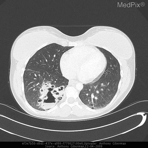 **Imaging Modality:** Axial Computed Tomography (CT) of the chest, lung window.