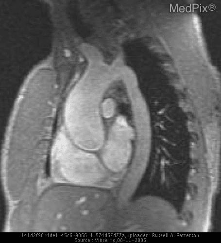 **Imaging Modality:** Cardiovascular Magnetic Resonance Imaging (MRI), specifically a sagittal-oblique view of the thoracic aorta (often referred to as a "candy cane" view).
**Anatomical Region:** Thoracic aorta, including the ascending aorta, aortic arch, and proximal descending aorta.
**Observed Pathology:** The image demonstrates a Bicuspid Aortic Valve (BAV) with associated aortopathy. There is significant aneurysmal dilatation of the ascending aorta, a common sequela of BAV. The aortic arch and descending aorta appear relatively normal in caliber compared to the prominent ascending segment.
**Characteristic Visual Features:**
- **Ascending Aorta:** Marked symmetric enlargement of the tubular ascending aorta.
- **Aortic Root:** The sinuses of Valsalva appear mildly prominent, contributing to the overall aneurysmal morphology.
- **Aortic Arch:** Intact arch anatomy with visualization of the origins of the great vessels.
- **Cardiac Chambers:** Partial visualization of the left ventricle and left atrium.
**Clinical Context:** Findings are consistent with a 38-year-old male presenting with a heart murmur, where the valvular morphology and secondary hemodynamic effects (dilation) provide the structural basis for clinical auscultation.
**Key Diagnostic Features:** Disproportionate dilatation of the ascending aorta relative to the descending aorta in a young patient, highly suggestive of a congenital bicuspid aortopathy.