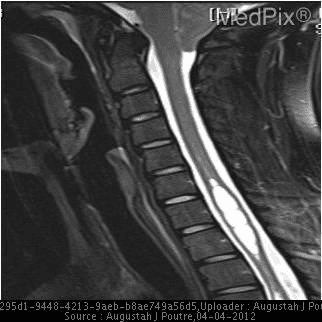 **Imaging Modality:** Sagittal T2-weighted Magnetic Resonance Imaging (MRI) of the cervical spine.