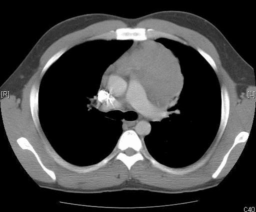 **Imaging Modality:** Non-contrast axial Computed Tomography (CT) of the chest.
**Anatomical Region:** Anterior mediastinum at the level of the aortic arch and pulmonary trunk.
**Observed Pathology:** A large, well-circumscribed, soft-tissue density mass is present in the anterior mediastinum. The mass is predominantly left-sided but crosses the midline, exerting a mass effect on adjacent vascular structures. It appears relatively homogeneous in attenuation.
**Characteristic Visual Features:**
* **Location:** Anterior to the ascending aorta and pulmonary artery, posterior to the sternum.
* **Morphology:** Lobulated borders with a solid internal composition.
* **Surrounding Structures:** The mass is in close proximity to the great vessels; however, no gross invasion of the lung parenchyma or pleural effusion is visualized in this single slice.
* **Vascular findings:** A hyperdense (calcified or metallic) focus is noted in the right hilar/paratracheal region, likely representing a calcified lymph node or surgical clip.
**Key Diagnostic Features:** The presence of a large anterior mediastinal mass in an adult necessitates the differential diagnosis of the "4 Ts": Thymoma, Teratoma (germ cell tumors), Thyroid (substernal goiter), and "Terrible" Lymphoma. The homogeneity and location are highly suggestive of a thymic epithelial tumor or lymphoma.