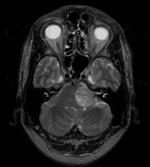**Imaging Modality:** Magnetic Resonance Imaging (MRI), T2-weighted axial sequence.