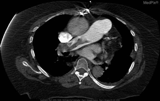 **Imaging Modality:** Contrast-enhanced Computed Tomography (CT) of the chest, specifically a CT Pulmonary Angiography (CTPA) protocol.
**Anatomical Region:** Axial section of the thorax at the level of the pulmonary artery bifurcation.
**Observed Pathology:** Large, bilateral pulmonary embolism. A prominent "saddle" embolus is visible, characterized by low-attenuation (hypodense) filling defects within the lumen of the main pulmonary artery, extending into both the right and left main pulmonary arteries.
**Characteristic Visual Features:**
* **Filling Defects:** Central non-opacified areas surrounded by radiopaque contrast media, creating the classic "Polo Mint" sign in cross-section or "railway track" sign in longitudinal views.
* **Vascular Anatomy:** The pulmonary trunk appears dilated.
* **Surrounding Structures:** The ascending and descending aorta, superior vena cava, and vertebral body are visible and unremarkable in this single slice. Metal streak artifacts are present anteriorly from sternal wires, suggesting prior cardiac surgery.
**Key Diagnostic Features:** The presence of a large, centrally located thrombus straddling the bifurcation of the pulmonary trunk (saddle embolus) is the pathognomonic finding for acute major pulmonary embolism.