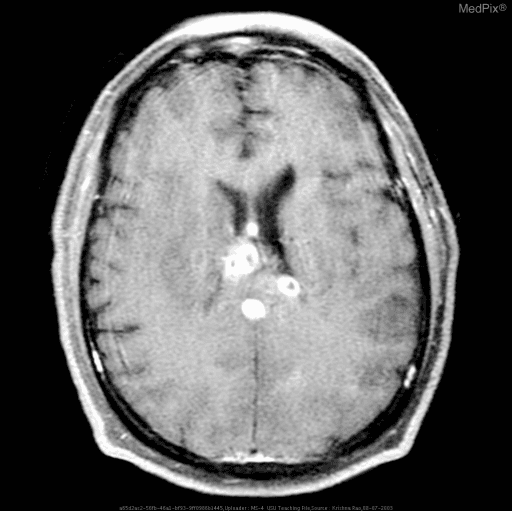 **Imaging Modality:** Axial T1-weighted contrast-enhanced Magnetic Resonance Imaging (MRI) of the brain.