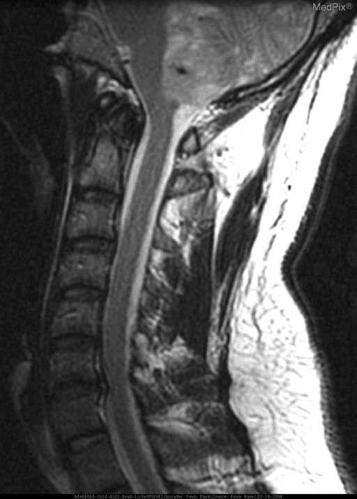 **Imaging Modality:** Sagittal Magnetic Resonance Imaging (MRI), T1-weighted sequence.