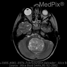 **Imaging Modality:** Magnetic Resonance Imaging (MRI), axial T2-weighted sequence.